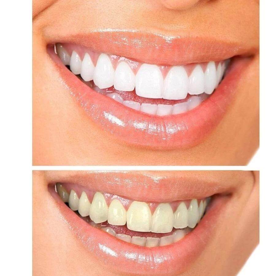 White Teeth for a Younger-Looking Smile